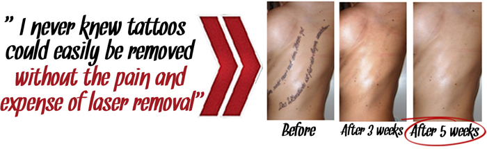 The Laserless Tattoo Removal Guide